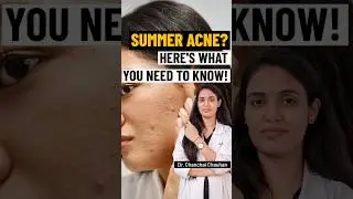 Summer Acne Breakouts: Why They Happen & How to Stop Them #acne #skincare #skinlogicsclinic #shorts