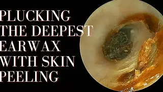 PLUCKING the Deepest Earwax With Skin Peeling