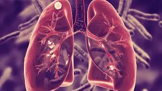 &iquest;QU&Eacute; ES LA TUBERCULOSIS? TODO LO QUE DEBES SABER