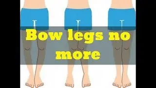 Bow legs no more review &ndash; Does Bow legs no more really work ?