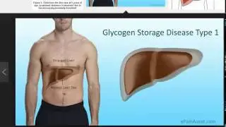 Von Gerke disease (type 1 glycogen storage disease)