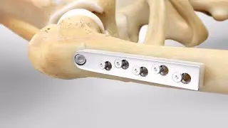 DHS(dynamic hip screw) procedure|| Anotomy|Fixation DHS plate