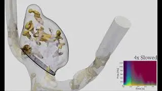 ICAD 2021 - Aneurisk case 0060 sonified visualization