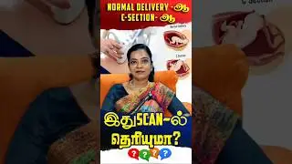 Normal delivery-or C-section-or is this what you see on the scan? #drvandanaa #csectionbirth #nor...