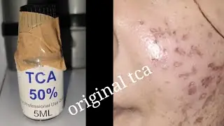TCA cross 50% || original t.c.a को कहा से खरीदें || full details #tcacross #cemicalpeel #skinpeeling