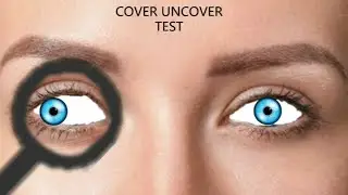 Cover test live demonstration #orthoptics
