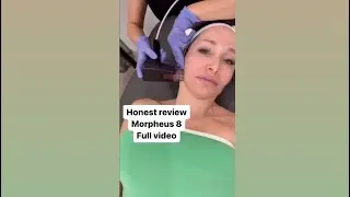 Morpheus 8, honest review