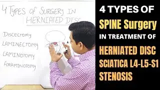 Lumbar Spine Surgery, L4-L5-S1-Herniated Disc, Canal Stenosis, Spinal Decompression, MICRODISCECTOMY