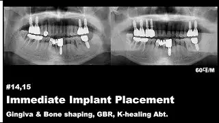 [Dental implant] #14,15 Buccal bone defect, Immediate..(Gingiva & Bone shaping, GBR, K-healing Abt.)
