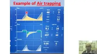 Lesson 9 : how to detect air trapping on ventilator
