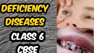 Deficiency diseases class 6 CBSE
