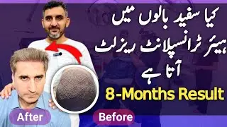 Is hair transplant result is possible in white hairs?