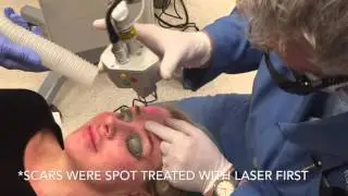 Dr. Kevin Pinski CO2 Laser Resurfacing Treatment Pinski Dermatology and Cosmetic Surgery Chicago