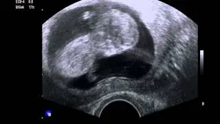 Unsere MiniRobbe in der 12. SSW 3. Video