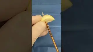 All-inside Meniscal Suture #menisco #meniscusrepair #ortopedia