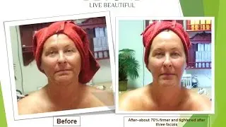 ~ WE ARE #1 SPECIALIZED IN ULTHERAPY FACE&NECK LIFT~