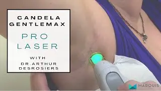 Laser spider veins