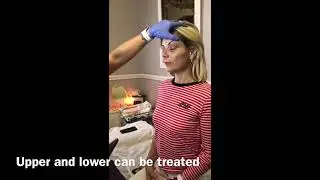 Fibroblast Eye Lift Treatment, the simplest explanation of what to expect!