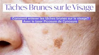 T&acirc;ches brunes sur le visage (hyperpigmentation de la peau) : retrait avec le laser picosure cynosure