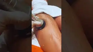 Ultrasonic Cavitation for Fat Reduction and Cellulite Treatment