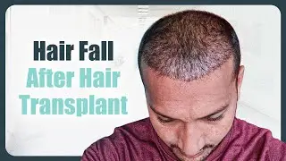 Why Does 'HAIR SHED' After Transplant? 🤔 | Hair Shedding Phase Explained | New Roots