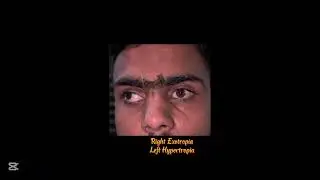 Cover Uncover test Revealing Right eye Exotropia and Left eye Exotropia along with Hypertropia