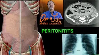 Peritonitis