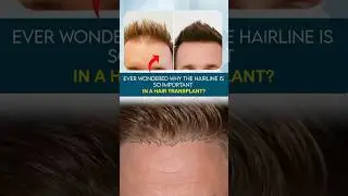 Why Hairline Design is the Key in Hair Transplant || Dr Anand Hair & Skin