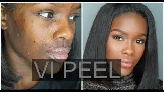 My 1st Chemical Peel Experience! | VI Peel
