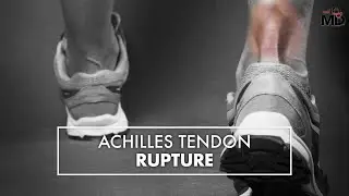 Achilles Tendon Rupture | Dr. Carr Vineyard | Top10MD