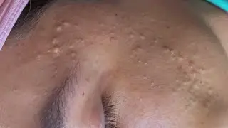 Blackhead Removal : Deep Pore Cleansing | Satisfying Routine 140