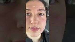 Before and after a peel