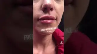Happy Hands Aesthetics LA Best Dermal Fillers | Lip Injections