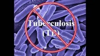 Tuberculosis PSA