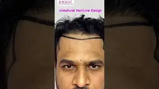 Hair Transplant Repair | Correction of Badly done Hairline Design by Dr Suneet Soni at Medispa