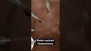 Removing the uterus (3D Animation)