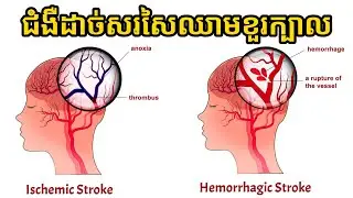 ជំងឺដាច់សរសៃឈាមខួរក្បាល | ចំណេះដឹងសុខភាព | success knowledge