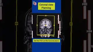 Brain MRI Planning ll axial ll coronal ll sagittal #mri #brain  #shorts