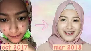 SKINCARE ROUTINE UNTUK MUKA BERJERAWAT | saritiw