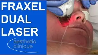 Fraxel Dual Laser - Non-Ablative Laser Resurfacing for Pigment and Precancers
