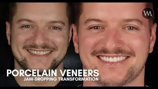 Porcelain Veneers Smile makeover | Before and After | Westmount Dental | UK