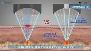 UTIMS with CENTERLESS HIFU - MSHAPE