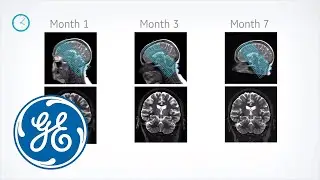 AIRx™: Intelligent MR slice prescription | GE Healthcare