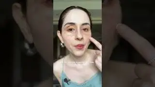 Can you believe this? #vitiligo