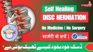 Disc Herniation | Self Healing | No Medicine No Surgery | Urdu/Hindi