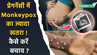 Monkeypox In Pregnancy Symptoms, Causes & Treatment In Hindi