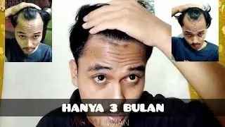 CARA MENUMBUHKAN RAMBUT BOTAK SAMPING atau BOTAK M atau BOTAK BEJITA hanya dalam 3 Bulan