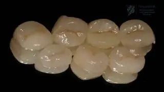 Case study: The difference between veneers, partial crowns and crowns