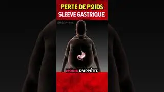 Sleeve gastrectomie