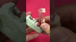Acrylic Partial